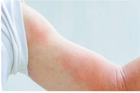 荨麻疹怎么止痒最快,荨麻疹缓解瘙痒的四个方法