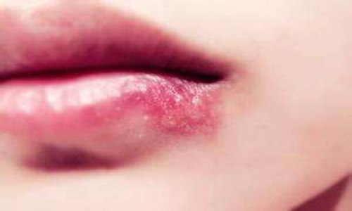 嘴唇上长水泡是什么原因？怎么治疗快速能消除