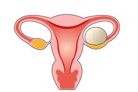 女人卵巢囊肿缠身的两大危害