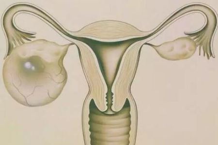 女人卵巢囊肿缠身的两大危害