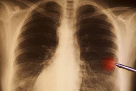 肺结节到底是怎么回事 体检发现肺结节该怎么办