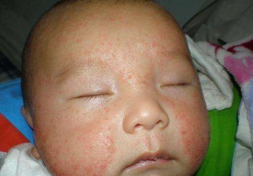 冬季宝宝湿疹又犯了，防治婴儿湿疹，这5招最靠谱！