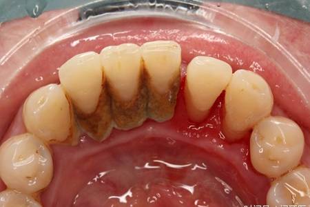 洗牙对牙齿有伤害吗,洗牙的注意事项有哪些