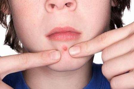女人下巴长痘痘是什么原因 2种小方法快速消除脸上青春痘