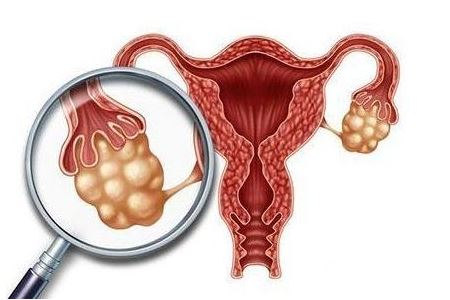 女人患有卵巢囊肿能怀孕吗