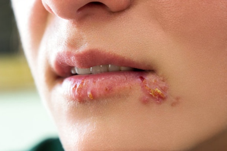 唇炎的症状,这五种唇炎的症状及治疗方法