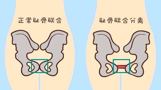 耻骨在身体哪个部位 孕妇耻骨是哪个部位图解