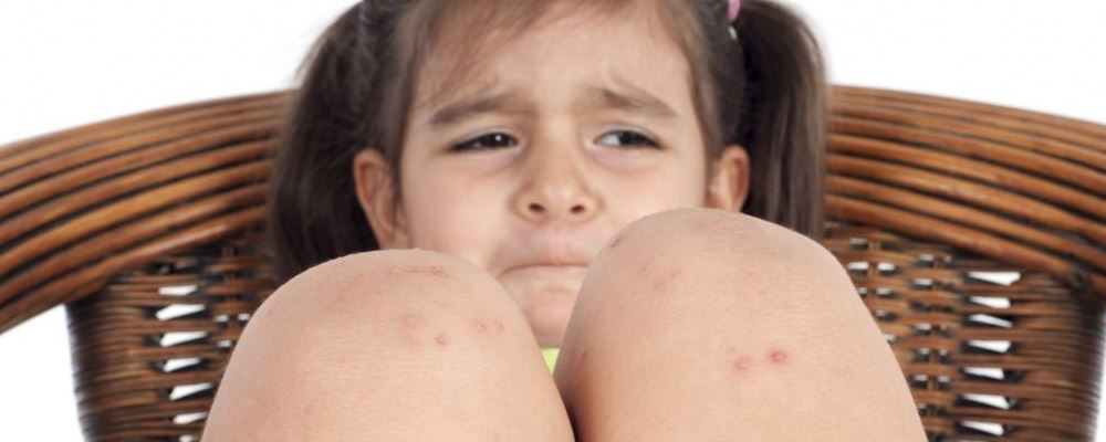 湿疹是秋季常见疾病 赶走湿疹可试试这些妙招
