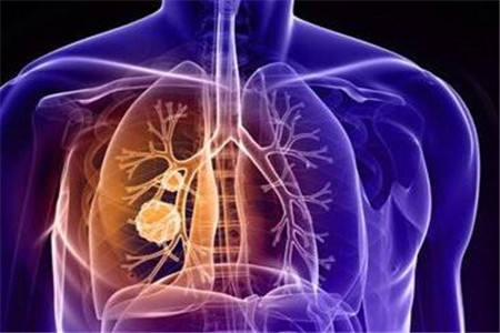 肺结核和肺炎的区别在于四点