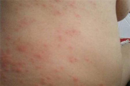 日常引起湿疹的五个原因