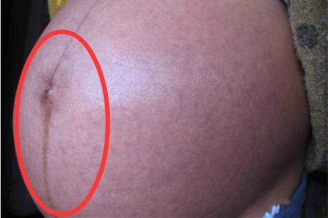 怀孕后肚子上的“黑线”是什么？妊娠中线的秘密,你有必要了解