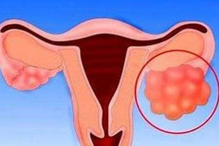 女人卵巢癌缠身的三个病因