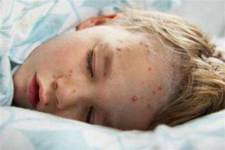 孩子出水痘的传染期是多少天