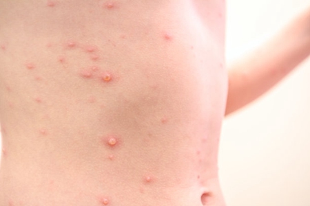 水痘的传染期是多少天？水痘的症状和治疗潜伏期