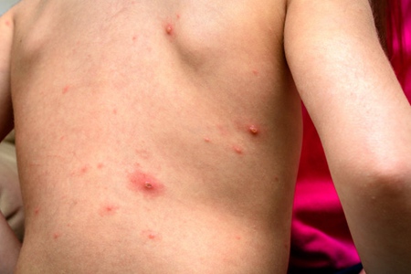 水痘的传染期是多少天？水痘的症状和治疗潜伏期
