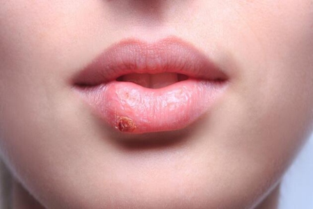 口腔疱疹症状有哪些？这三个口腔疱疹病毒感染的症状