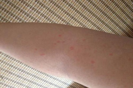 身体上有小红点是什么病？这3种疾病会引发皮肤上有小红点