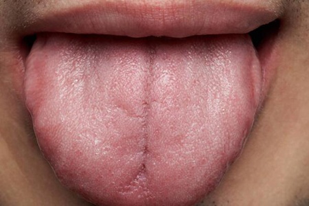 舌头有裂纹是怎么回事？舌头上有红色的小肉粒
