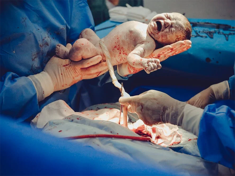胎儿刚出生就哭了,是因为剪脐带很疼吗？