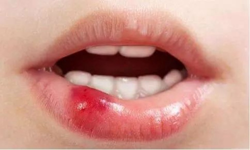 口腔溃疡怎么治好的最快 吃什么药止疼又能愈合