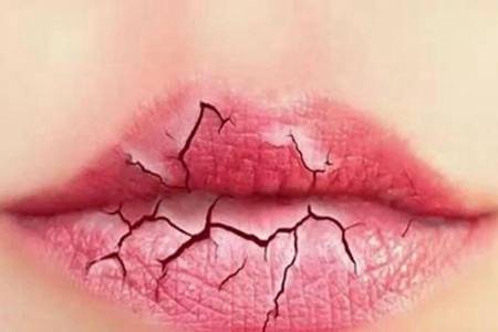 嘴唇越舔越干怎么回事 嘴唇干裂脱皮是什么原因造成的