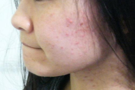 右脸长痘痘是什么原因？这五个女人右脸颊长痘的原因