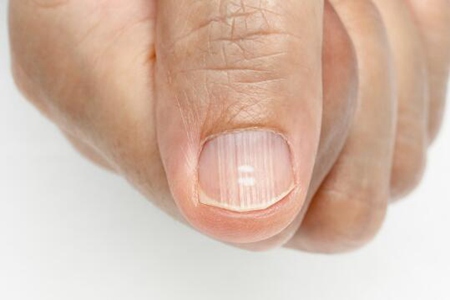 手指甲有竖纹是怎么回事？这五个造成手指甲有竖纹的原因