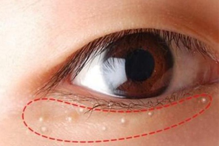 脂肪粒怎么消除在眼睛旁边的？这四个眼部脂肪粒去除方法