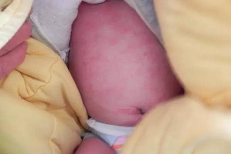 宝宝湿疹怎么处理最好办法？这四个宝宝湿疹最佳治疗方法