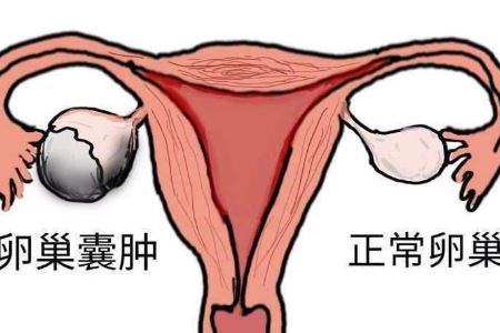 女人得卵巢囊肿的原因以及治疗方法