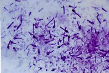 马王堆曾发现中国最早结核菌