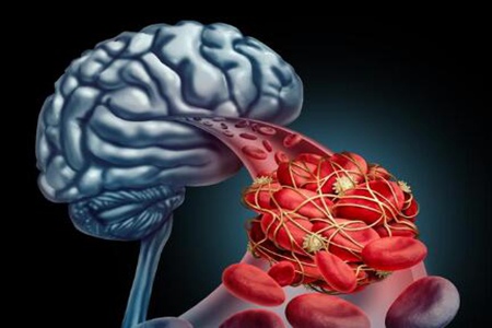 脑出血是怎么引起的？这四个诱发脑出血症状及表现