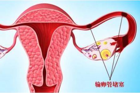 女人输卵管堵塞的两大常见原因