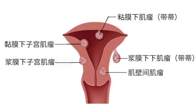 当怀孕遇上子宫肌瘤,「剪不断，理还乱」该怎么办？