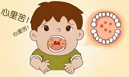 疱疹性咽峡炎高发期,孩子5岁前易中招！医生建议家长速看