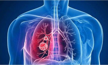 西安治疗肺部疾病名医贾宁讲解肺部肿瘤和肺癌的区别