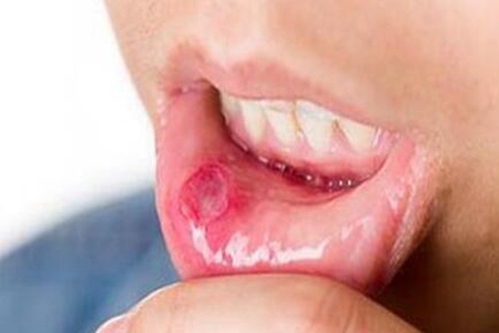 口腔溃疡怎么快速好？这三个缓解疼痛症状的方法