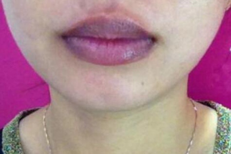嘴唇发紫是什么原因？这四个症状引发及时治疗
