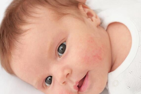 宝宝长湿疹怎么办？这四个方法护理是重点