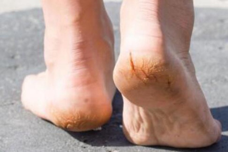 脚后跟干裂起硬皮是什么原因怎么治,这三个引发脚后跟干裂的原因