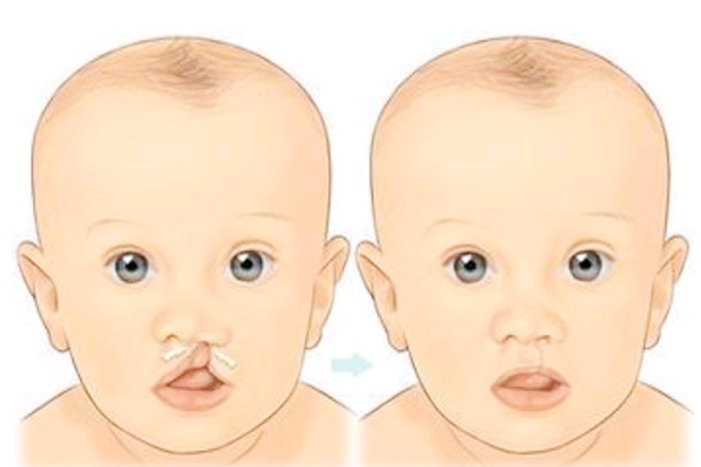 为何在孕期正常吃叶酸,胎儿还会＂唇腭裂＂？孕妈别耍小聪明了