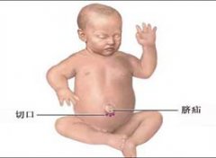 【新生儿脐疝】新生儿脐疝症状_新生儿脐疝的治疗方法