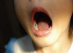 【儿童龋齿】_儿童龋齿的原因_儿童龋齿怎么治疗