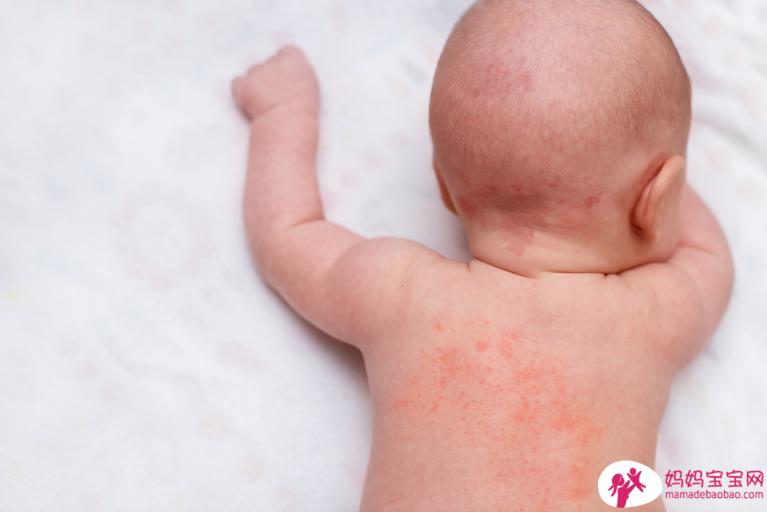 夏日宝宝皮肤常见5大问题：热疹、异位性皮肤炎！爸妈必知的照护方法
