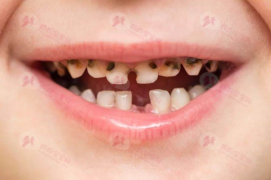 孩子长蛀牙之后的常见处理方法