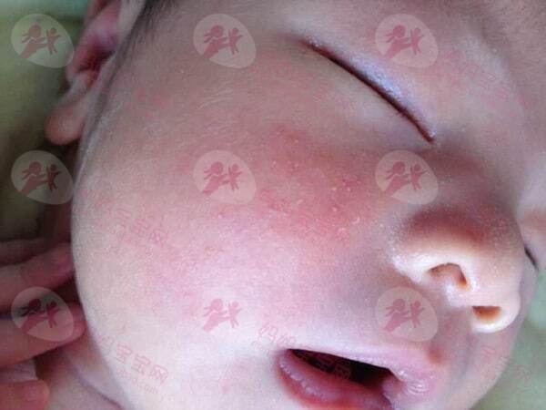 新生宝宝皮肤护理指南：婴儿湿疹、尿布疹、脂溢性皮炎