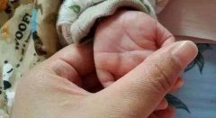 解读新生儿双手断掌：医学角度看待可能存在的问题