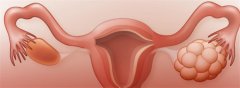 揭秘多囊卵巢的成因：遗传、内分泌失调与激素异常