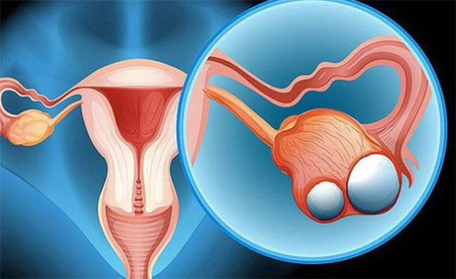 卵巢癌复发时间及前兆详解
