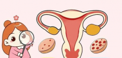 多囊卵巢综合征：治疗方法解析